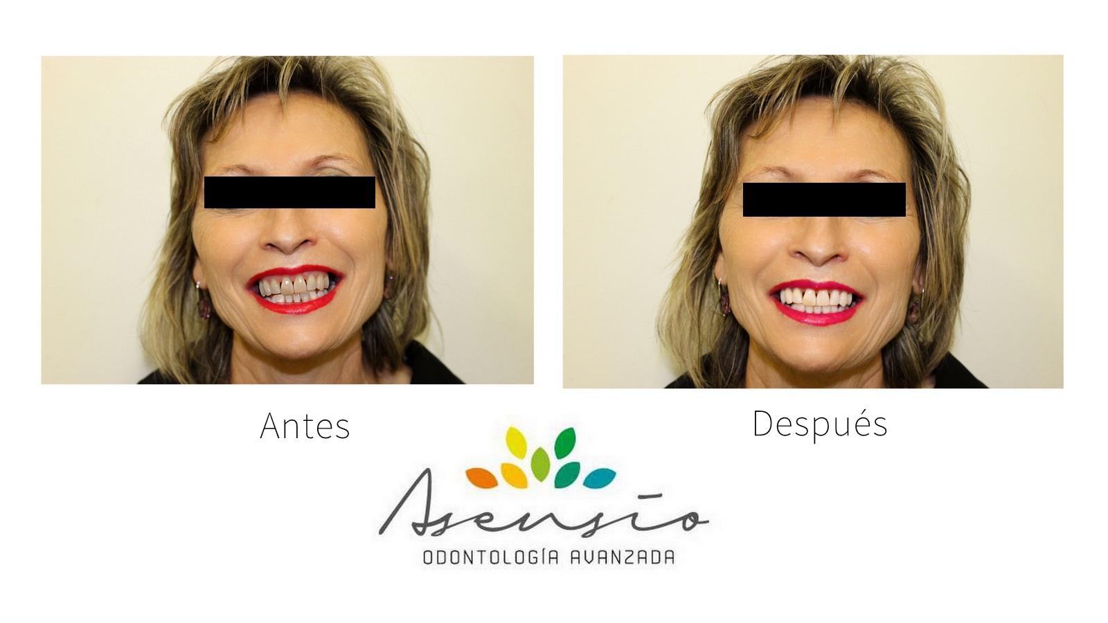 antes y después blanqueamiento dental valencia