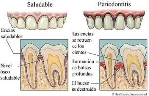periodontitis