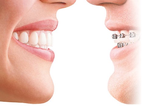 Invisalign