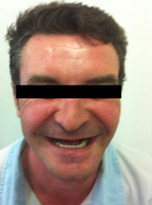 Implantes dentales en Valencia
