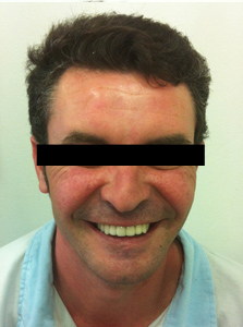 Implantes dentales en Valencia