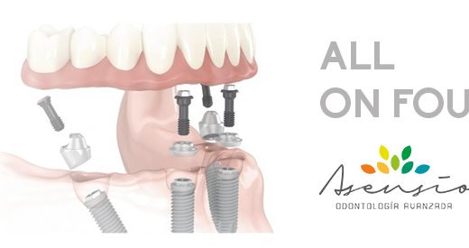 Implantes dentales con All on four: la técnica más actual para recuperar la dentadura.