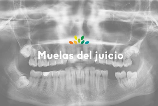 ¿Debería quitarme las muelas del juicio?