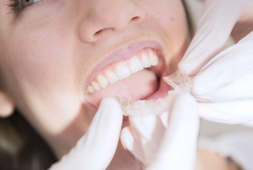 Bioestética dental: Ortodoncia invisible INVISALIGN