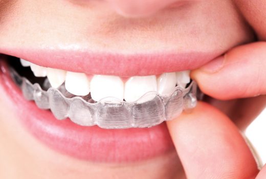 INVISALIGN, la ortodoncia invisible que sustituye a los brackets