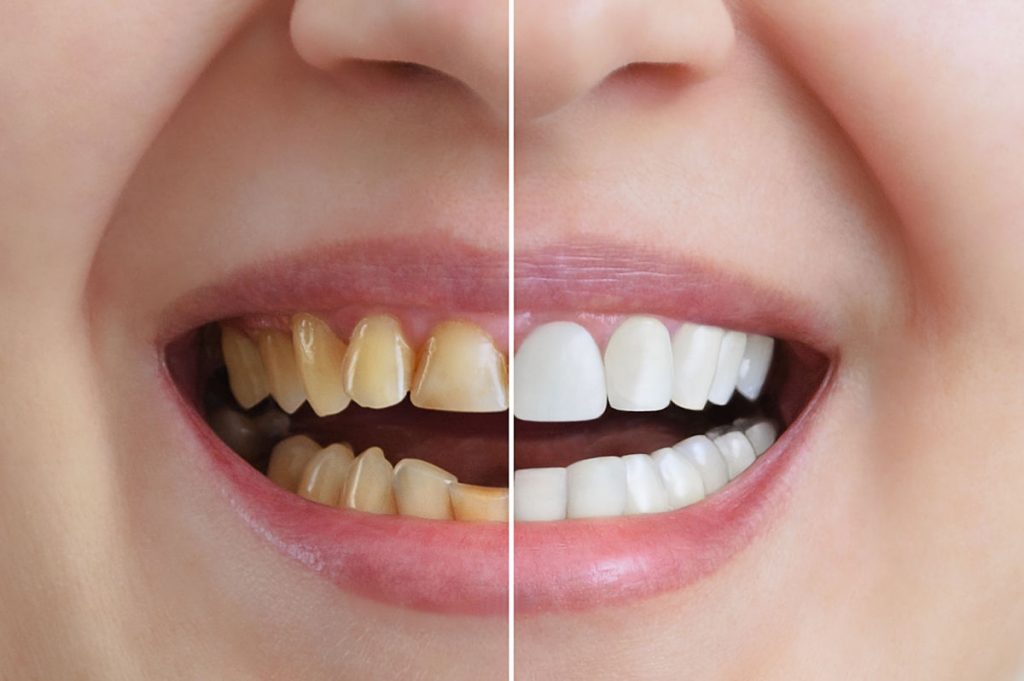 Consigue la sonrisa con la que sueñas con las carillas dentales - Clínica  Dental Valvanera
