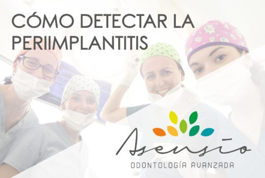 Cómo detectar la periimplantitis