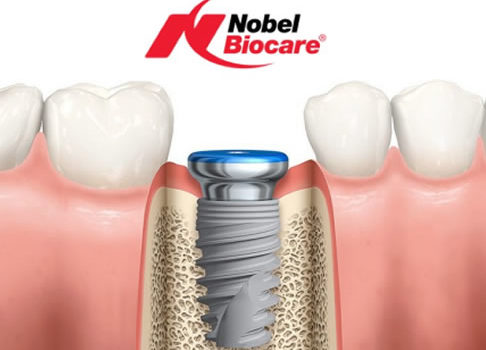 ¿Me pueden colocar implantes dentales si me falta hueso?