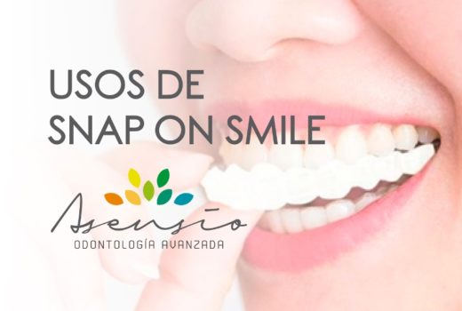 ¿En qué consiste Snap on Smile?