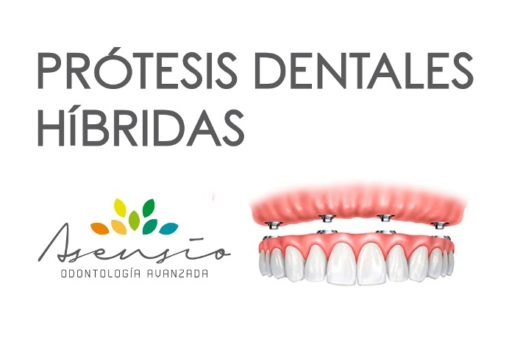 PROTESIS HIBRIDA DENTAL