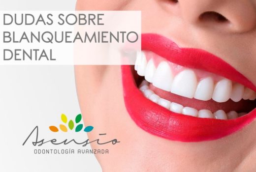 DUDAS SOBRE BLANQUEAMIENTO DENTAL