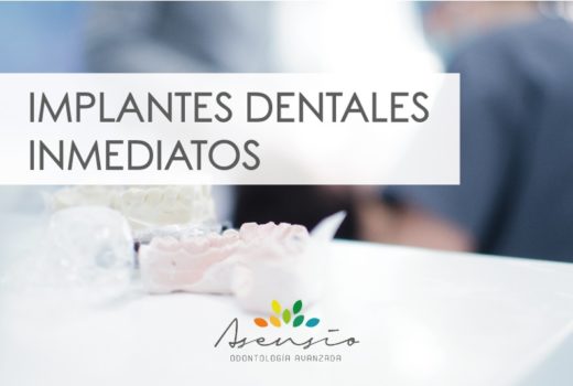 IMPLANTES DENTALES INMEDIATOS. LA MEJOR SOLUCION EN ASENSIO ODONTOLOGIA AVANZADA