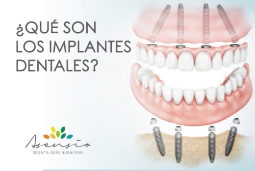 ¿QUÉ SON LOS IMPLANTES DENTALES?