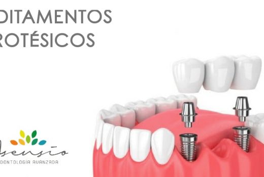 ¿Qué son los Aditamentos Protésicos para implantes dentales?