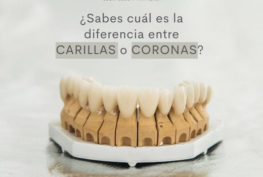 ¿Conoces la diferencia entre carillas y coronas dentales?
