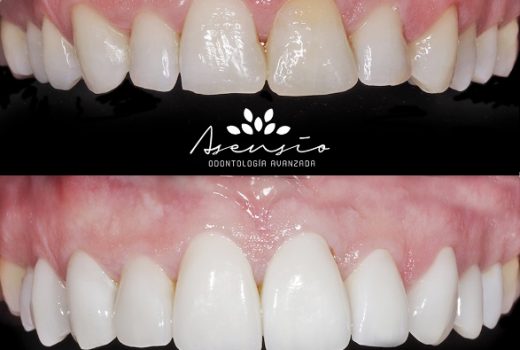 Microcarillas feldespaticas y blanqueamiento dental en Clinica dental Asensio
