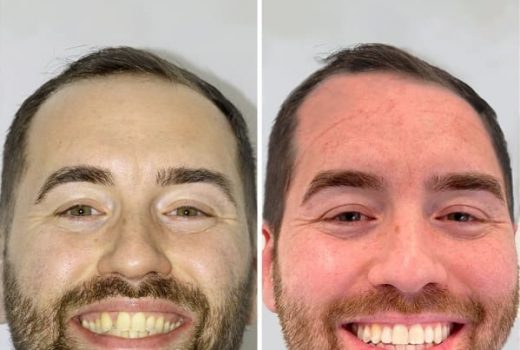 CASO CLINICO: ANTES Y DESPUES DE TRATAMIENTO DE ORTODONCIA INVISALIGN