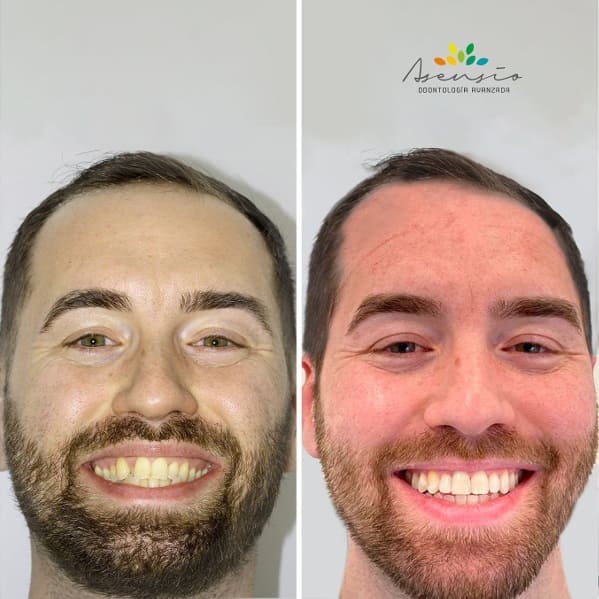CASO CLINICO ANTES Y DESPUES DE TRATAMIENTO DE ORTODONCIA INVISALIGN Dental Asensio, tu CASO CLINICO ANTES Y DESPUES DE TRATAMIENTO DE ORTODONCIA INVISALIGN Dental Asensio, tu