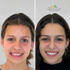 قبل و بعد از ارتودنسی برای کودکان