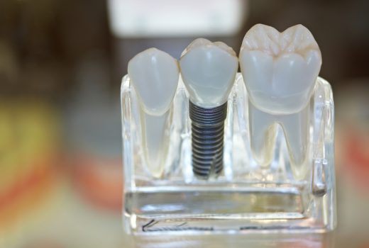 Implantes dentales: la información que necesitas