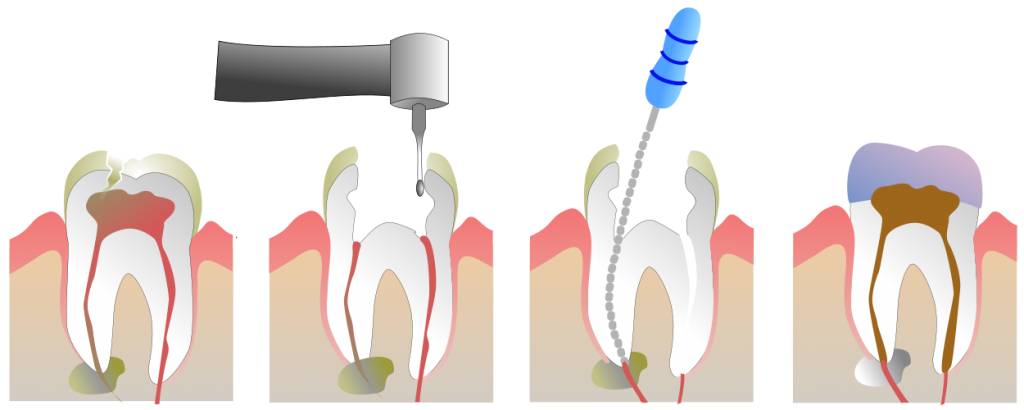 endodoncia