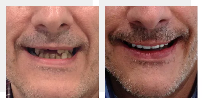 caso de implantes dentales antes y después