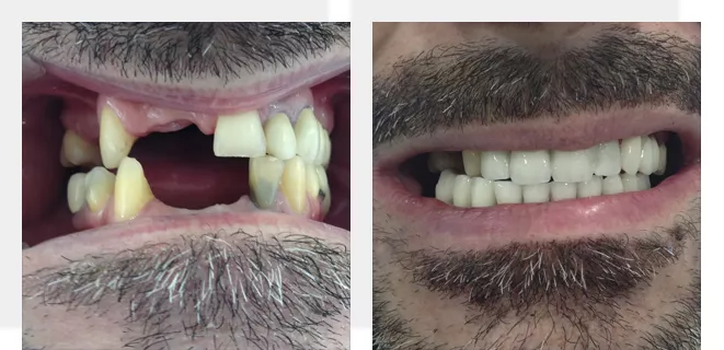 caso de implantes dentales antes y después