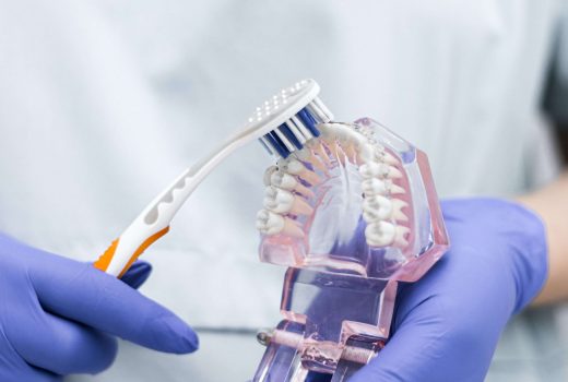 ¿QUÉ ES LA DENTADURA FIJA SOBRE 4 IMPLANTES?