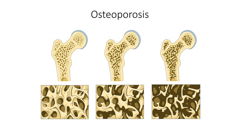 Osteoporosis en huesos