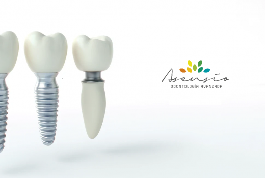 Precio Implante Dental de 3 Piezas