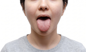 lengua agrietada