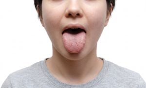 lengua_agrietada