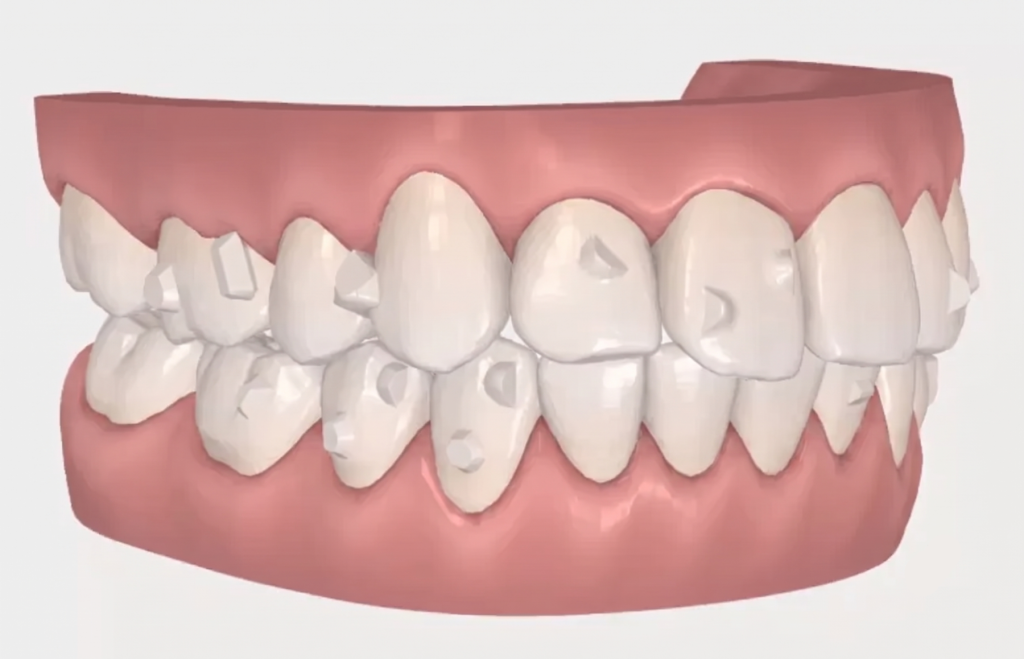 ataches invisalign 3